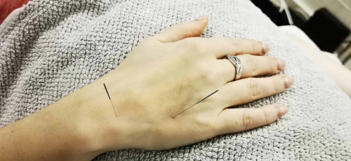 Beata_Acupuncture_1_scaled.webp