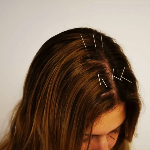 Zhu Scalp Acupuncture