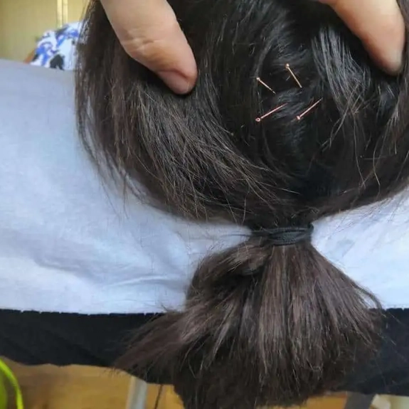 Zhu Scalp Acupuncture - Acupuncture in Reading, Berkshire and Surrounding Areas - Lina Doyle
