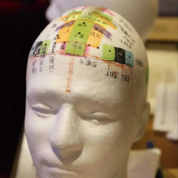 Zhu Scalp Acupuncture - Acupuncture in Reading, Berkshire and Surrounding Areas - Lina Doyle