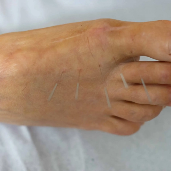 Balance Method Acupuncture By Dr Richard Tan - Acupuncture in Reading, Berkshire and Surrounding Areas - Lina Doyle