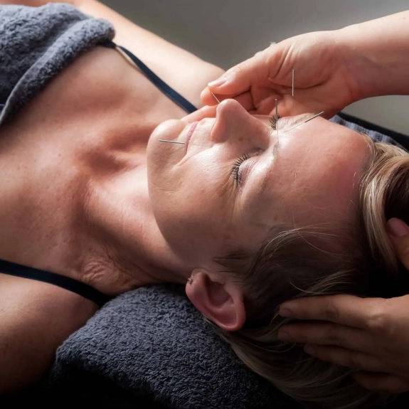 Facial Cosmetic Acupuncture
