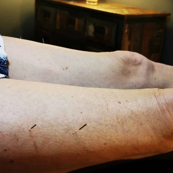 Master Tung's Acupuncture - Acupuncture in Reading, Berkshire and Surrounding Areas - Lina Doyle
