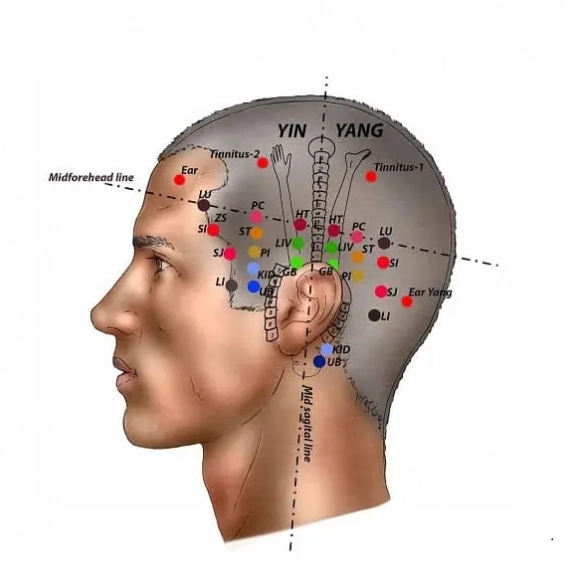 Yamamoto Scalp Acupuncture