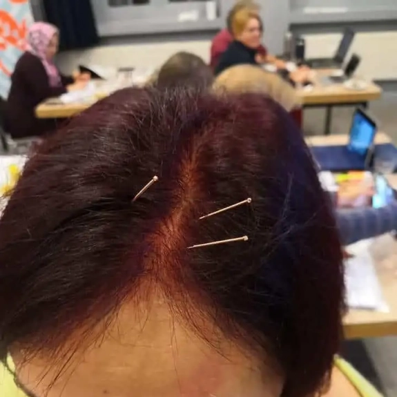 Yamamoto Scalp Acupuncture - Acupuncture in Reading, Berkshire and Surrounding Areas - Lina Doyle