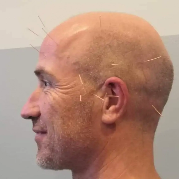 Yamamoto Scalp Acupuncture - Acupuncture in Reading, Berkshire and Surrounding Areas - Lina Doyle