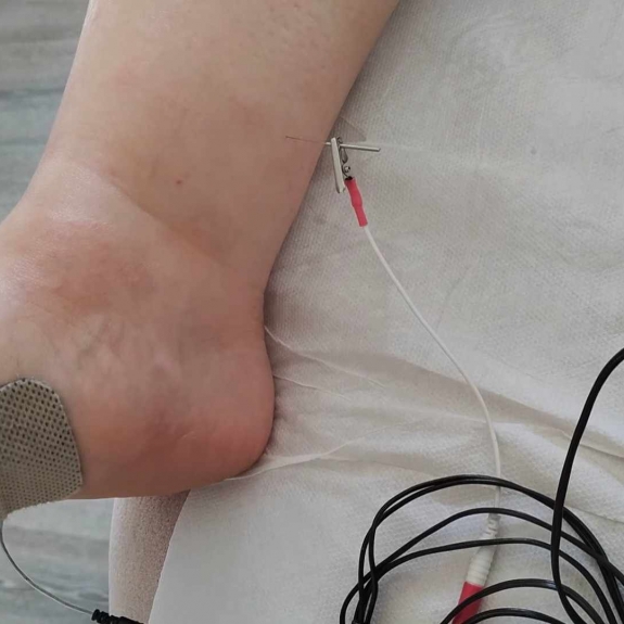 Electro Acupuncture - Acupuncture in Reading, Berkshire and Surrounding Areas - Lina Doyle