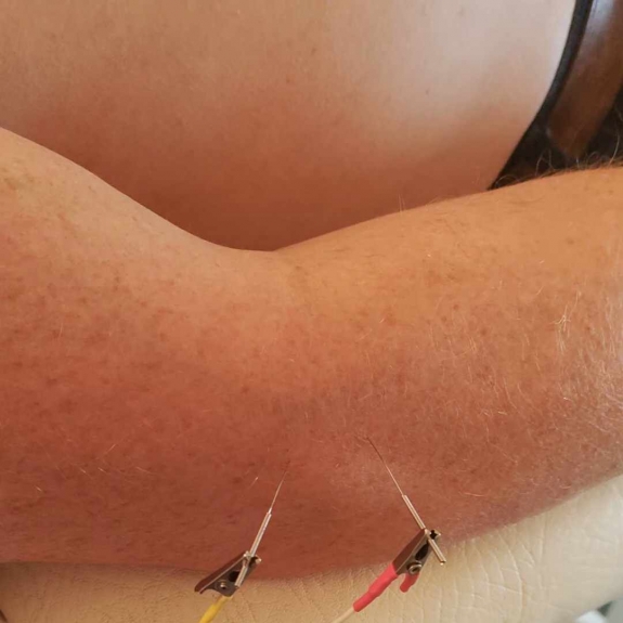 Electro Acupuncture - Acupuncture in Reading, Berkshire and Surrounding Areas - Lina Doyle