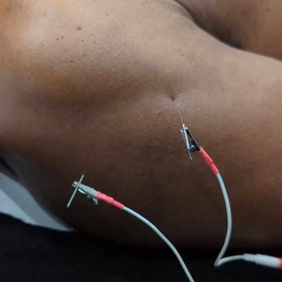 Electro Acupuncture - Acupuncture in Reading, Berkshire and Surrounding Areas - Lina Doyle
